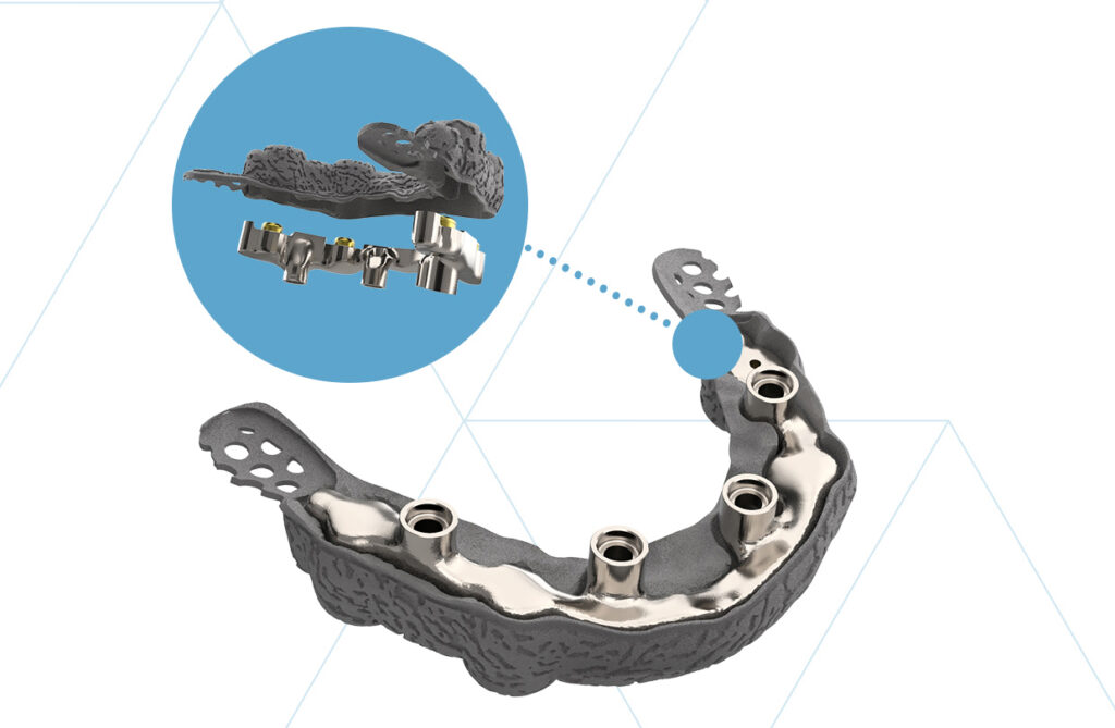 Supra estructura para sobredentadura