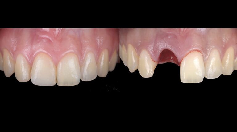 Imagen intraoral post-exodoncia