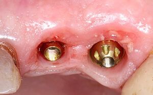 Figura 2. La substitución de un pilar transepitelial clásico por un Slim permite acumular tejido blando tanto en la zona vestibular como palatina, disminuyendo la presión sobre la mucosa y liberando tensión sobre la cresta ósea, favoreciendo una mayor preservación de los tejidos periimplantarios.