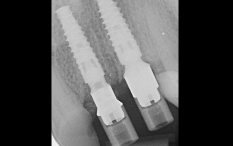 Figura 3. Radiografía postoperatoria de los implantes con el pilar transepitelial, un SLIM y un clásico con un óptimo comportamiento de los tejidos periimplantarios.