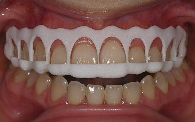 Férula de gingivectomía