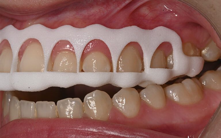 Férula de gingivectomía
