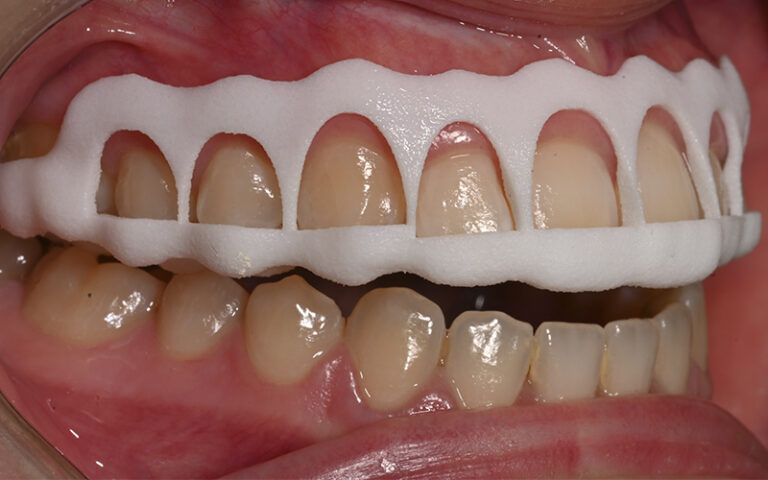 Férula de gingivectomía